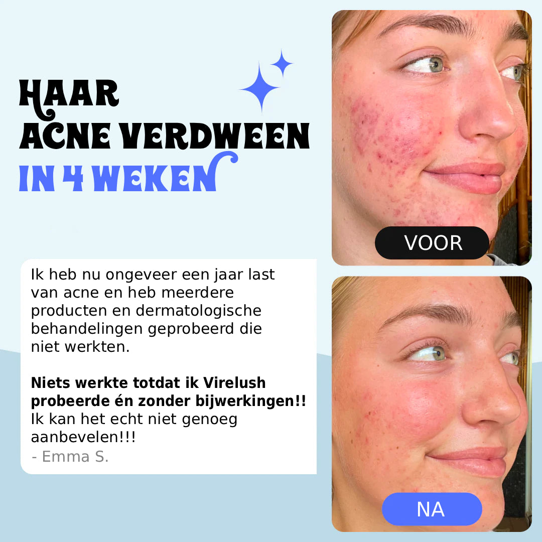 Behandeling voor Tieneracne & Herstelt de Buid