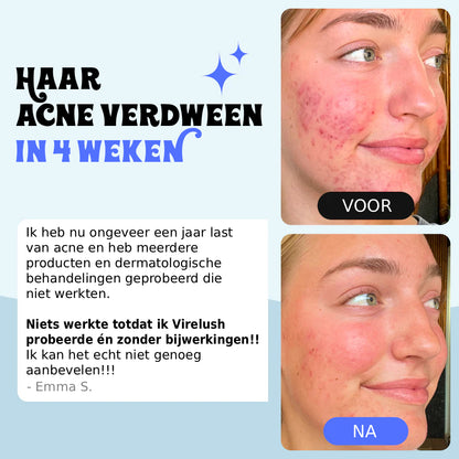 Behandeling voor Tieneracne & Herstelt de Buid