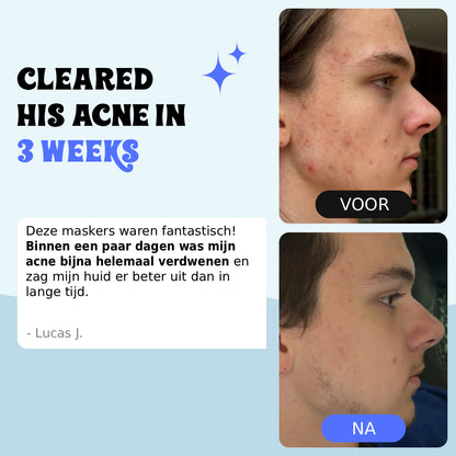 Behandeling voor Tieneracne & Herstelt de Buid